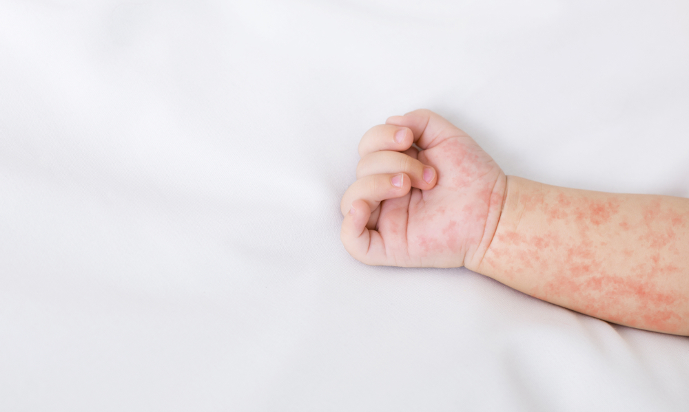 measles